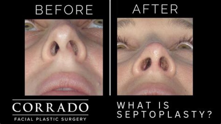 At what age can you get septoplasty?