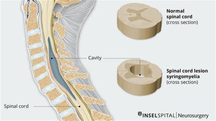 Can you live a long life with syringomyelia?