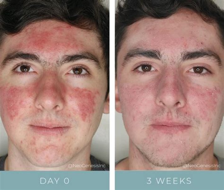 How do you get rid of acid burn on skin?