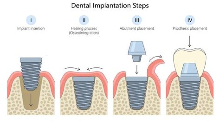 How do you prove dental implants are medically necessary?
