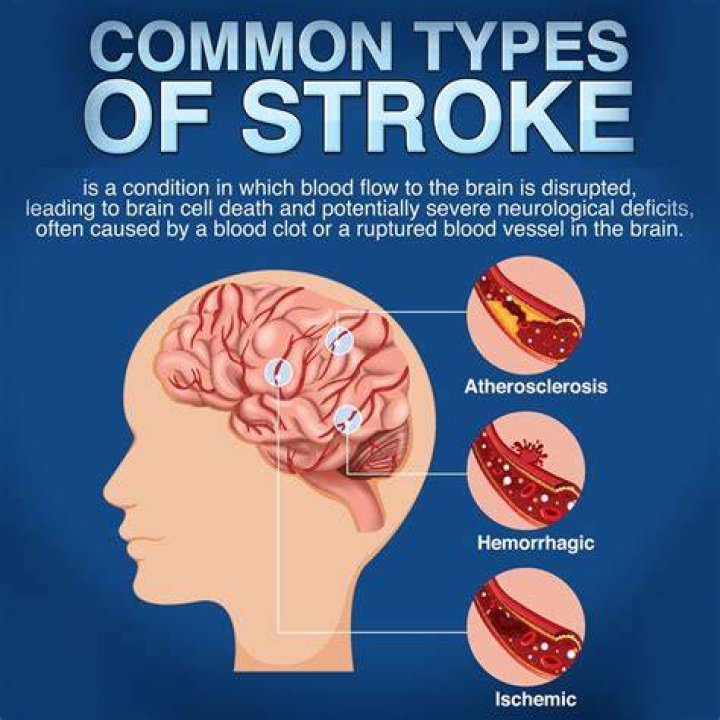 What do you do when your dad has a stroke?