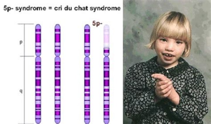 What is the survival rate of Cri du Chat?